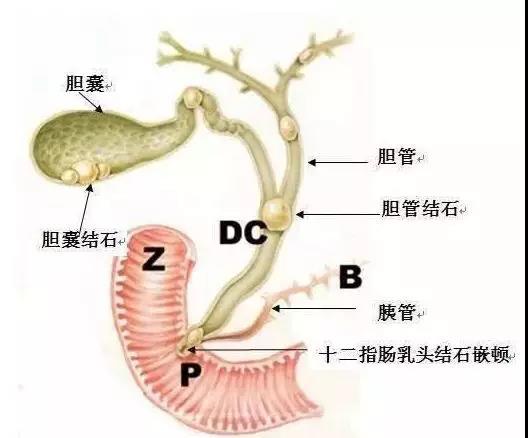 不建议年轻人随意切除胆囊(年轻人胆囊切除了对身体有什么影响?)