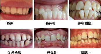 隐形牙齿矫正