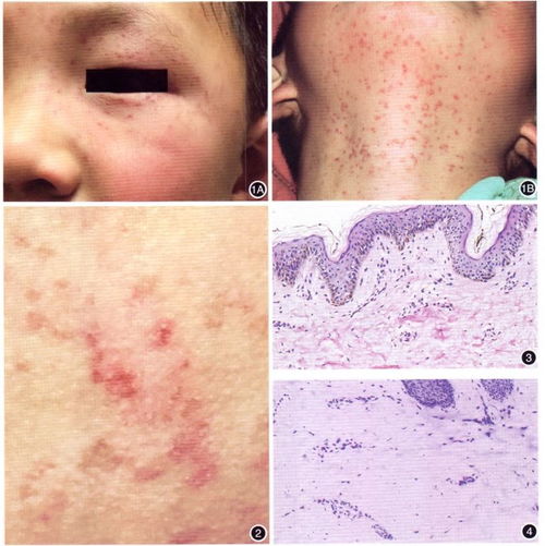 儿童持久性发疹性斑状毛细血管扩张症一例 