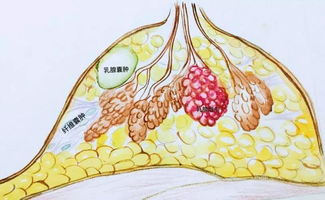 乳腺导管扩张怎么治疗(乳腺导管扩张怎么治疗吃什么药)