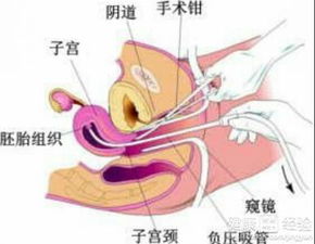 人工流产可以吃虾螃蟹鱿鱼等海鲜吗