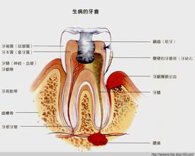 广州治疗牙髓炎哪种方式好 