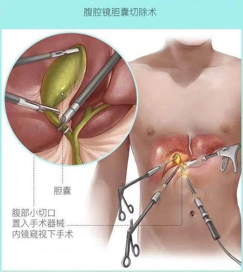 查出胆结石怎么办 切还是不切