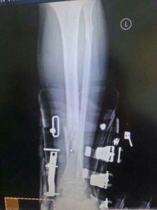 曝央视名嘴韩乔生滑雪意外受伤 左腿两处骨折 