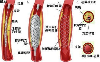 动脉导管未闭的临床表现