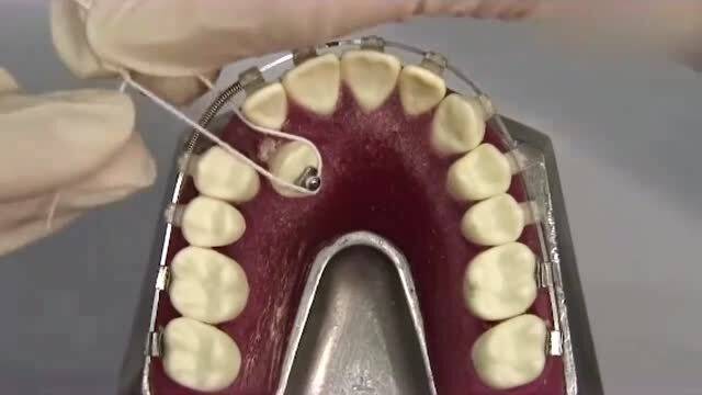 你是这样的牙齿类型吗,看看怎么矫正的,现在的科技真是进步了 