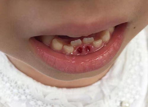 孩子出现双排牙,需不需要将乳牙拔掉 医生提醒 要视情况而定