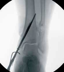 Am J Orthop 双皮质螺钉固定治疗内踝骨折