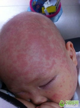 宝宝发烧后出疹子(三岁的娃娃发烧后出红疹子是怎么回事)
