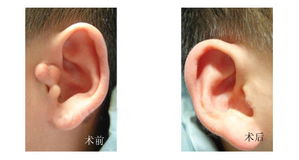 副耳畸形如何矫正