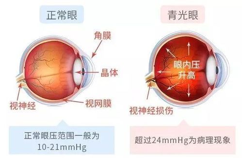 天气寒冷,老年人需要预防哪些眼疾