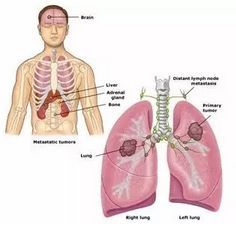 搜狐公众平台 你必须了解的肺癌转移 一 