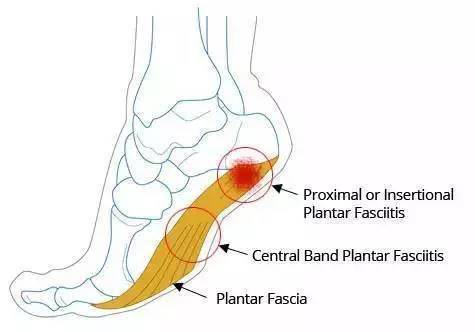 足底筋膜炎的自我康复方法