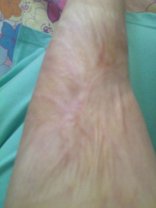 我大腿上有大面积的烫伤疤痕,这疤痕都十几年了,怎样去除呢 