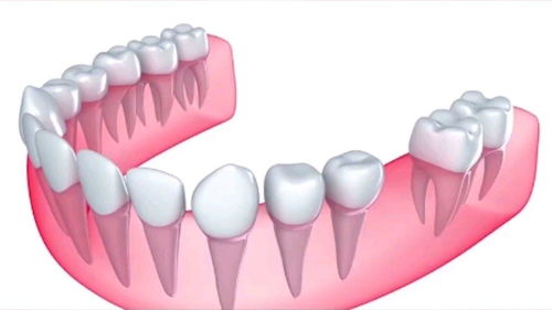 牙齿缺失一颗怎么办 可以选择这样修复 