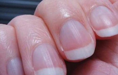 指甲表面有明显的竖纹是怎么回事
