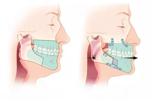 正颌手术是什么