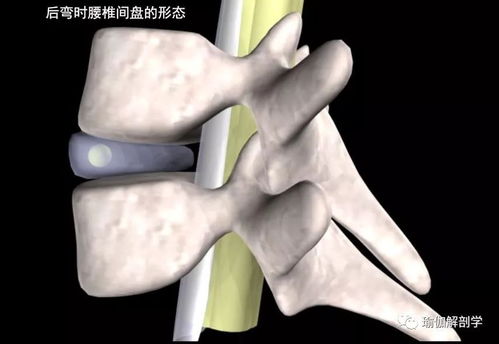 老师,腰椎间盘突出的人不能练什么瑜伽动作