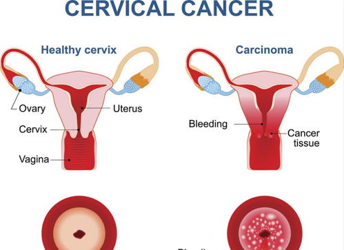 00后情侣双双感染HPV,医生忠告 不管男女,1处长疙瘩,速查HPV