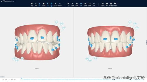 医生不建议拔牙矫正怎么办呀