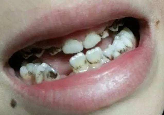 龋齿对身体有害吗