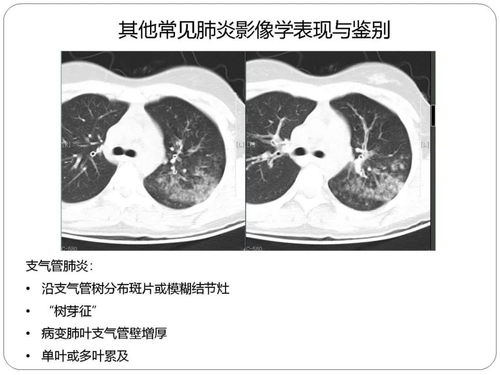 新冠起病急吗（新冠病开始有什么症状） 第1张