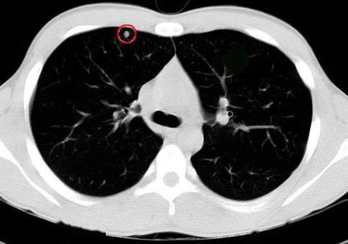 肺部结节灶,看看影像科医生怎么处理