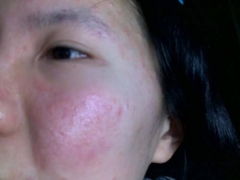 脸部皮肤过敏有哪些常见原因