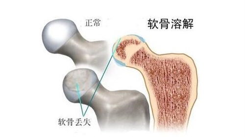 股骨头坏死常用那此药比较有较