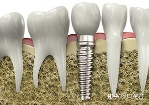 昆明种植牙的成功率有多少 