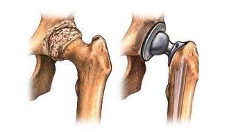人工关节置换术可靠吗