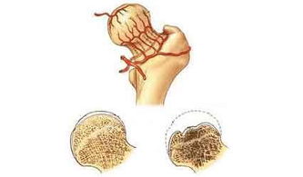 股骨头坏死用什么药