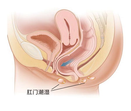 肛门潮湿什么原因引起的(肛门潮湿是什么原因引起的,怎么治疗)