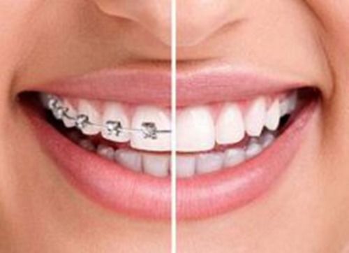 大连齿医生口腔 牙齿矫正的7大效,你造吗