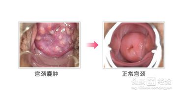 宫颈囊肿上用什么药