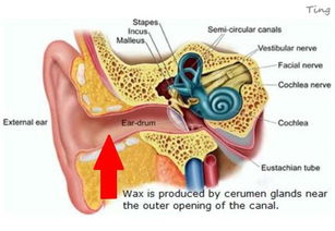 习惯每天用棉签清理耳朵 看看专家怎么说 