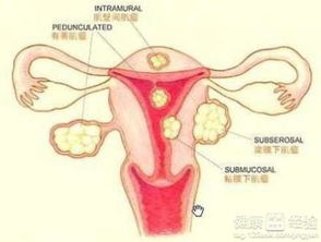 多发性子宫肌瘤的治疗方法