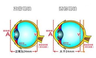 关于近视的有哪些知识