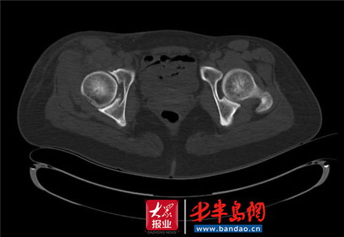 罕见 27岁男子胯骨轴痛 手术取出81颗游离 珍珠 