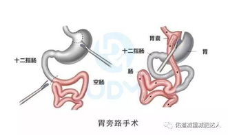 女子胖达977斤,10壮汉砸墙抬去做胃旁路术减肥,胃旁路有多神奇 