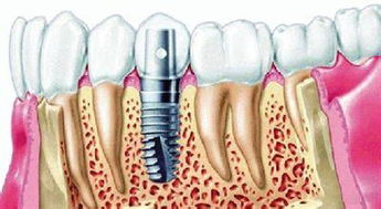 求无锡种植牙价格 种植牙为甚嫩么贵,种植牙的利与弊 