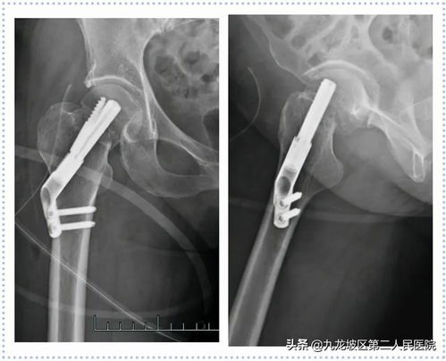 22张高清X线片 带你看清胯骨骨折手术前后对比