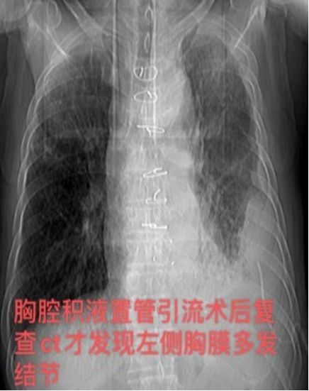 息县人民医院介入超声诊断实施实时可视引导胸膜活检术