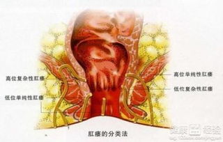 肛瘘手术后能否骑车干农活