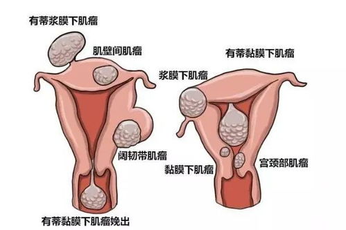 38岁女子 怀孕 5年 到医院切开肚皮傻眼了,一共有45个