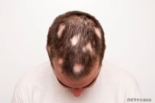 斑秃是什么原因造成的 斑秃怎么治疗效果好 别着急 这里告诉你斑秃怎么办