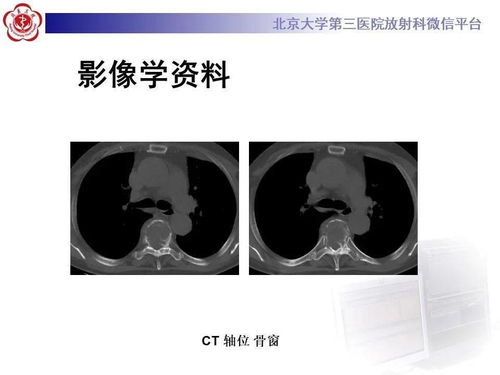 女性,67岁症状 右胸部疼痛2月余,逐渐加重