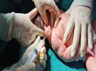 医生隔着孕妇肚皮为胎儿做穿刺手术 