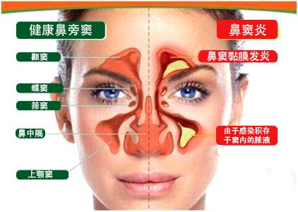 副鼻竇炎頭疼怎麼辦