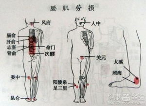 腰肌劳损刮痧疗法